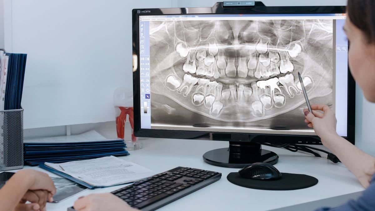 Cone Beam en Implantología